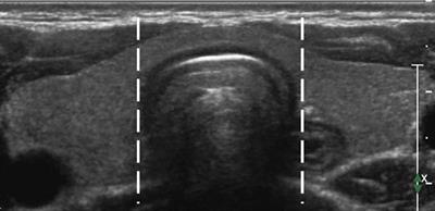 Evaluation of Ultrasound-Guided Radiofrequency Ablation as a Treatment Option for Papillary Thyroid Microcarcinoma in the Isthmus: A Retrospective Study